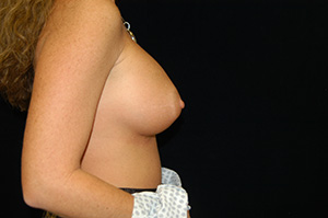 Breast Augmentation 7d